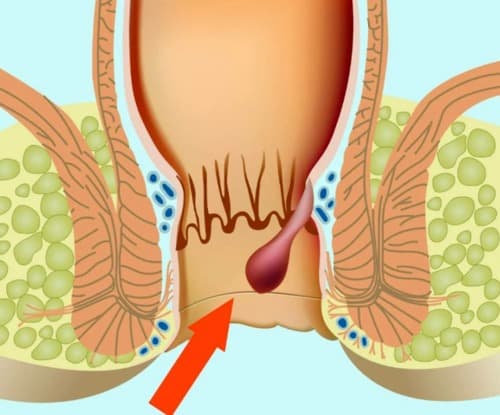 Hemorrhostop ดีจริงไหม