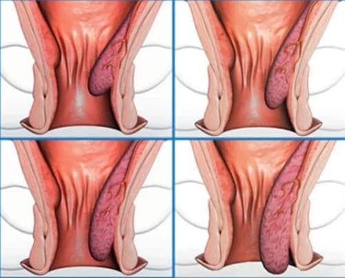 Hemorrhostop คือ