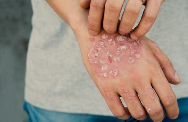 psoriasis-is-caused-by