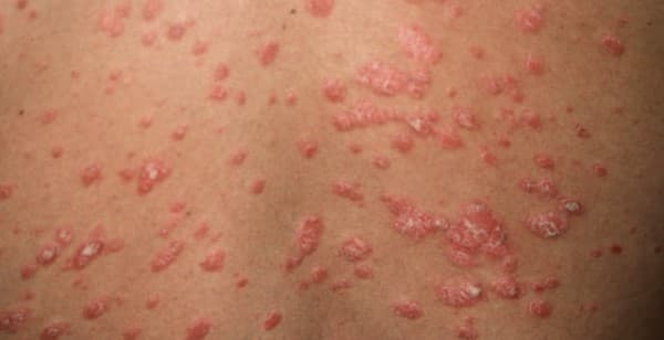 psoriasis-is