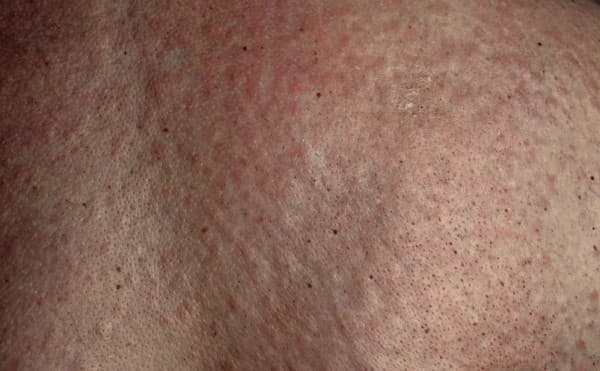 psoriasis-symptoms