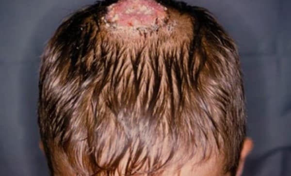 ringworm-on-the-head